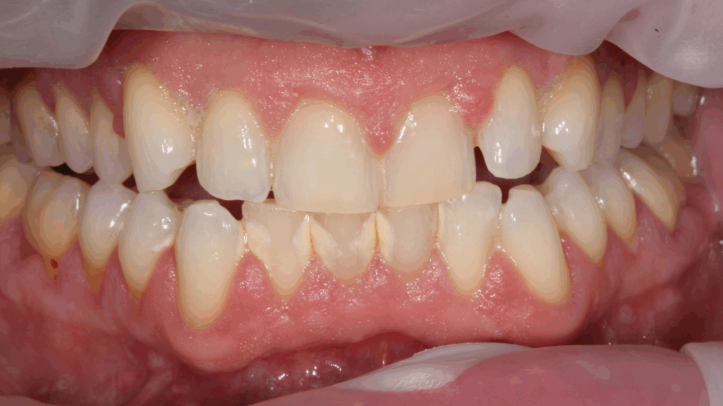 Step 1 Trattamento malattia parodontale con la GBT