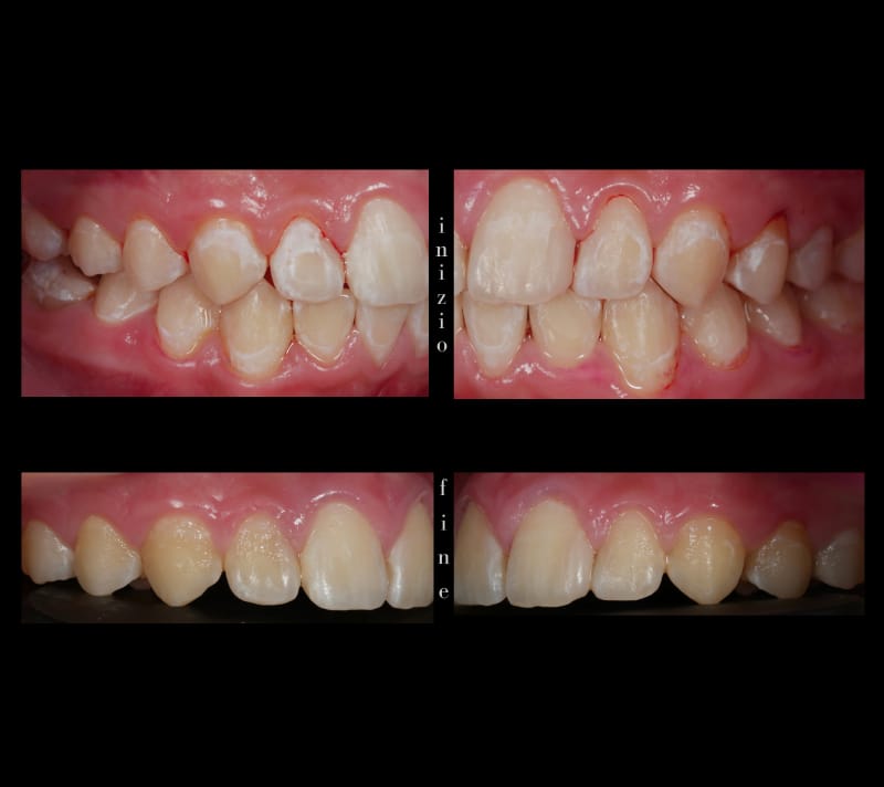 Caso studio Chiara Casagrande pre e post