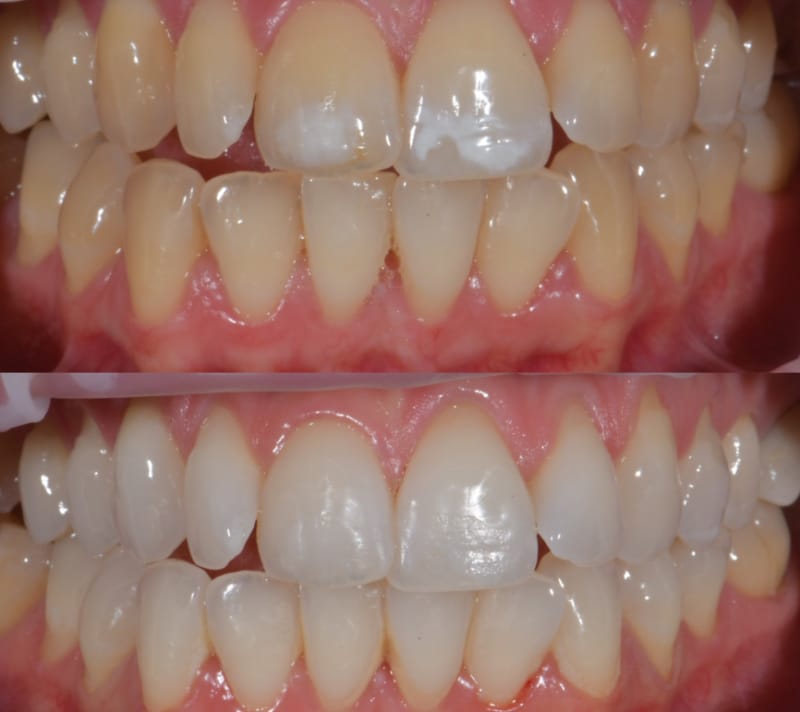 Caso studio Pre e post Alice Bianchi