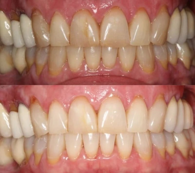 Caso studio Pre e post Laura Kostner